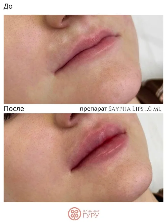 Увеличение губ (аугментация губ) препаратом Saypha Lips 1 мл: фото до и после